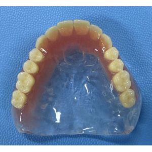 Hypoallergenic Customized Removable Partial Denture With Pink Gum Color