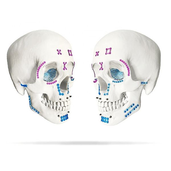 Maxillofacial Mini Locking L Plate 1.0mm System Thickness Titanium