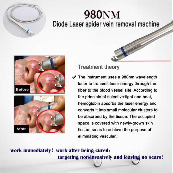 Professional 980nm Spider Vein Removal Machine – 60W Medical Laser Therapy for Flawless Skin!