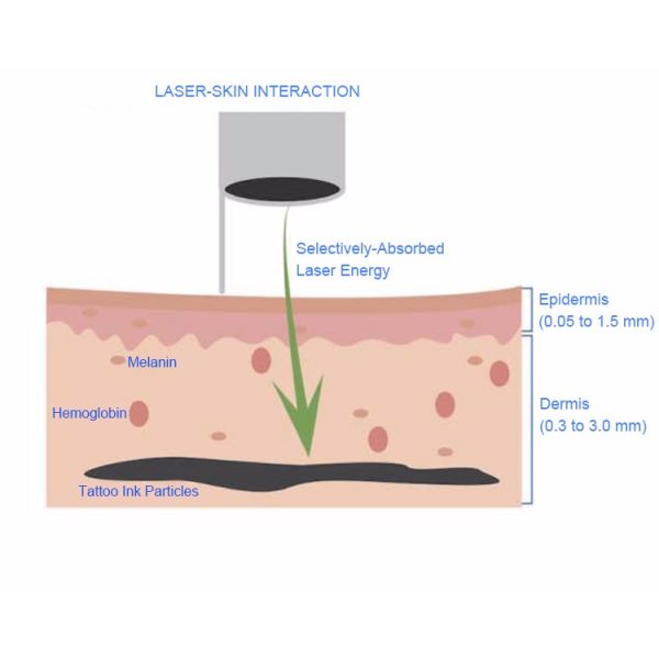 The Best Q Switched ND Yag Laser Made In China with Big Promotion