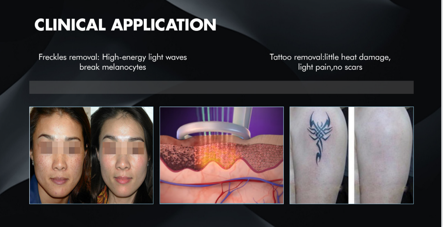 12.1 Inch Touch Screen High Power Q Switch Nd Yag Picosecond Laser For Tattoo Removal