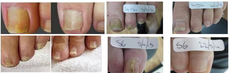 980nm Spider Vein Removal Machine