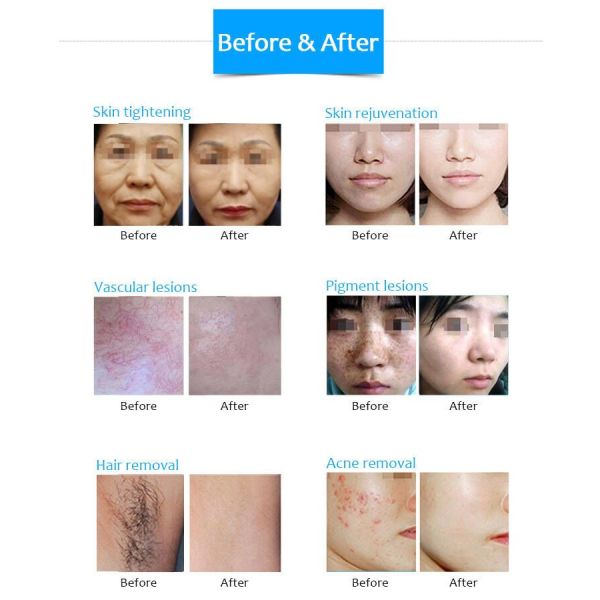 Multifunctional Diode Laser Nd Yag Tattoo Removal laser IPL Super Hair Removal 4 IN 1