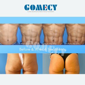 Hot Sale Trusculpt Flex Slim Body Sculpting Slimming Machine Trusculpt Emsmuscle