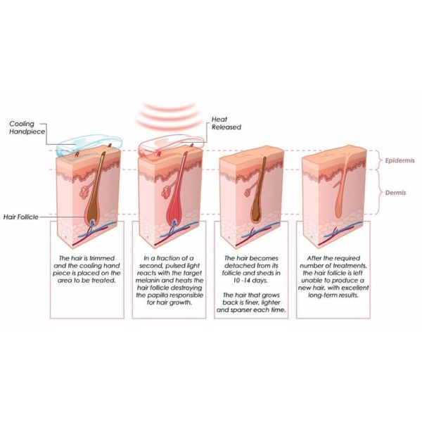 3000w 4 Wave Laser Hair Removal Machine 808nm Diode Laser Painless Permanent Hair Removal and Skin Rejuvenation for Sale