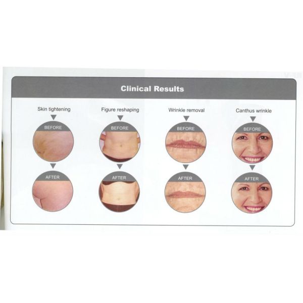 rf face skin tight machine