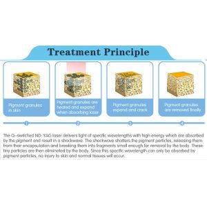 Promotion！laser skin clinic ND:Yag Laser Tattoo Removal/Skin Rejuvenation Unit