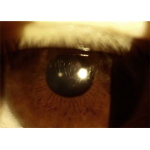 Handheld Slit Lamp Portable Ophthalmoscope Camera