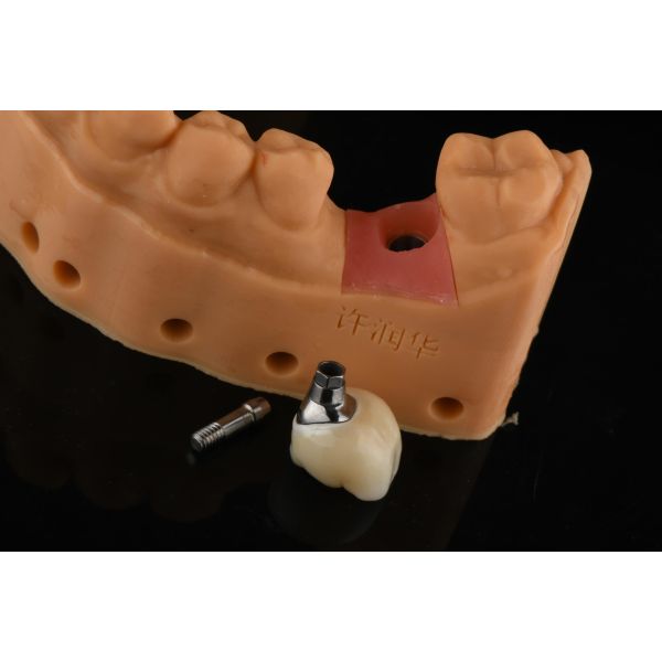 Buy Precision Cylindrical Silver Single Tooth Replacement Implants Dental Restoration at wholesale prices