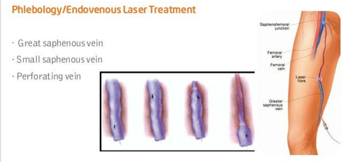 980 Nm Diode Laser Spider Vein Machine For Vascular Removal