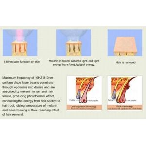 808nm Diode Laser Hair Removal Machine Permanent For Men Or Women