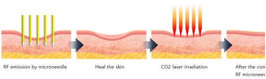 Wellness center Fractional RF Microneedle Acne Scar Removal Beauty Machine