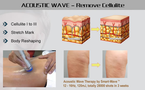 AWT Acoustic Cellulite Treatment Machine Fat Reduction