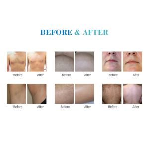 Professional ice soprano laser diode device hair removal triple wave medical