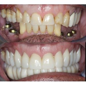 Yucera 4D Pro Zirconia Blanks Custom Dental Restoration Solutions