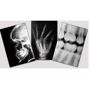 Blue Medical Dry Imaging Film , 11in x 14in Laser Fuji X Ray Film