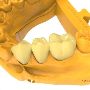 Biocompatible Permanent Crown Bridge Resin Hot Deformation Temperature 80C