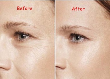 Low Price 1ml 2ml Injectable Hyaluronic Acid Dermal Filler For Anti Wrinkles