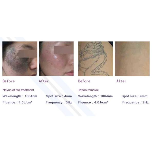 Portable Pigmentation Removal Machine , Q Switched Nd Yag Laser Tattoo Removal Machine