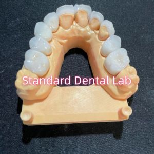 High Esthetic Hollywood Smile Milling Emax Laminate Veneers