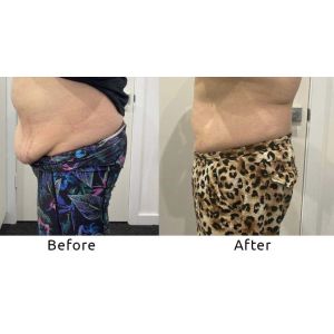 Coolwaves Machine Cryotherapy Cool Radio Frequency Ems Muscle Stimulation Body