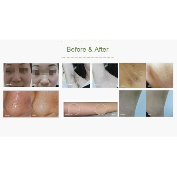 Compact Structure IPL SHR Hair Removal Machine RF Energy 1 Year Free Warranty