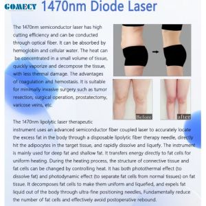 Professional Laser Lipo Machine Lipolysis Endolaser 980nm 1470nm Endo Face