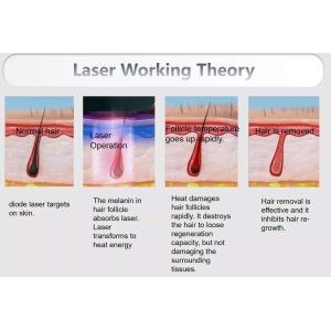 Custom Logo Diode Laser Hair Removal Machine 755nm 808nm 1064nm 16bar Laser Bar