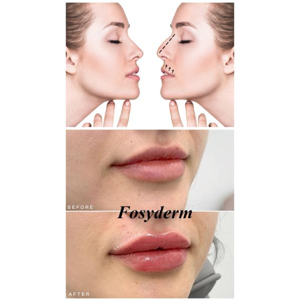 Calcium Hyaluronic Acid Injectable Dermal Filler For Facial Plastic
