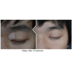 308nm Targeted Laser Treatment Vitiligo Excimer Light Phototherapy