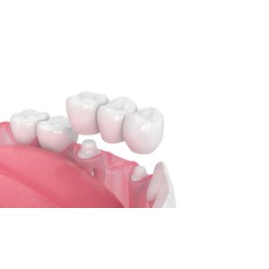 Porcelain Dental Crown Acid And Alkali Resistance Good Biocompatibility
