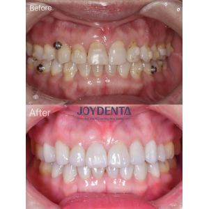 Porcelain Veneer Oral Restoration