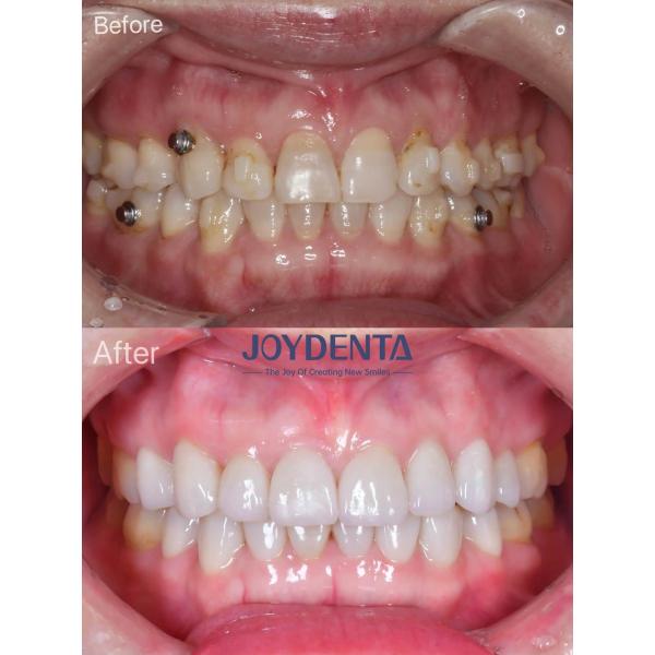 Buy Porcelain Veneer Oral Restoration at wholesale prices