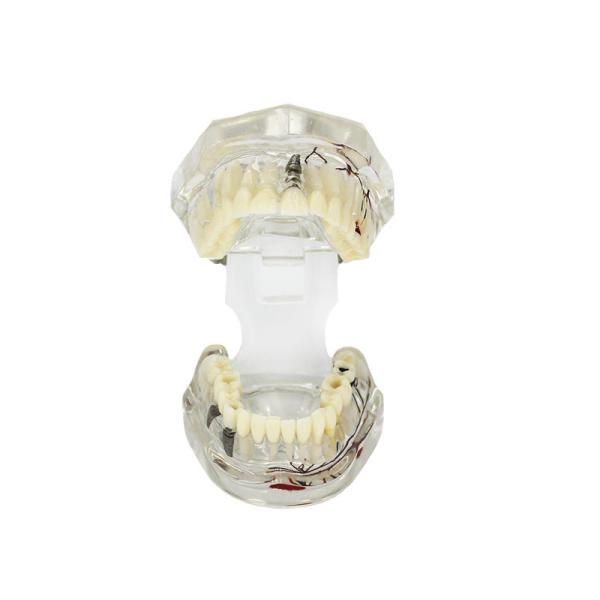 Buy Transparent Pathological Tooth Model Dental With Tooth Nerve Customization at wholesale prices