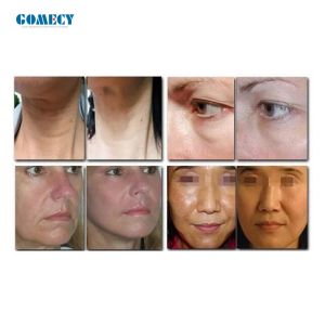 No Needle Skin Rejuvenation Mesoterapia Machine