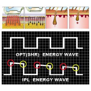 Opt SHR Hair Removal Laser With Strong Cooling