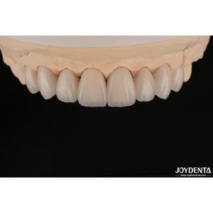 Feldspathic Natural Looking Cosmetic Veneers Precise Fit Highly Translucent