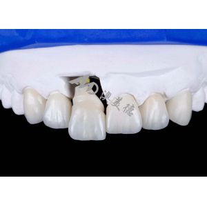 China Dental Implant Crown with Titanium Abutment For Natural Looking Smiles on sale