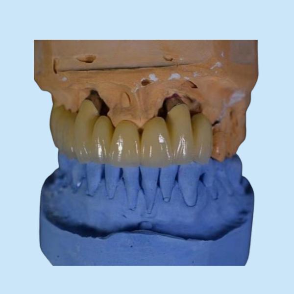 FDA PFM Crown Porcelain fused to Metal Crown