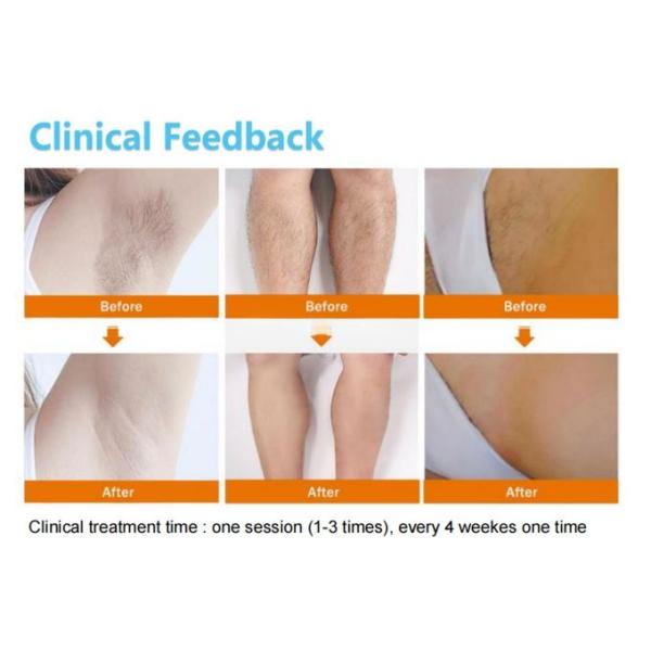 Fast and Efficient Diode Laser Hair Removal Machine for Men and Women 0