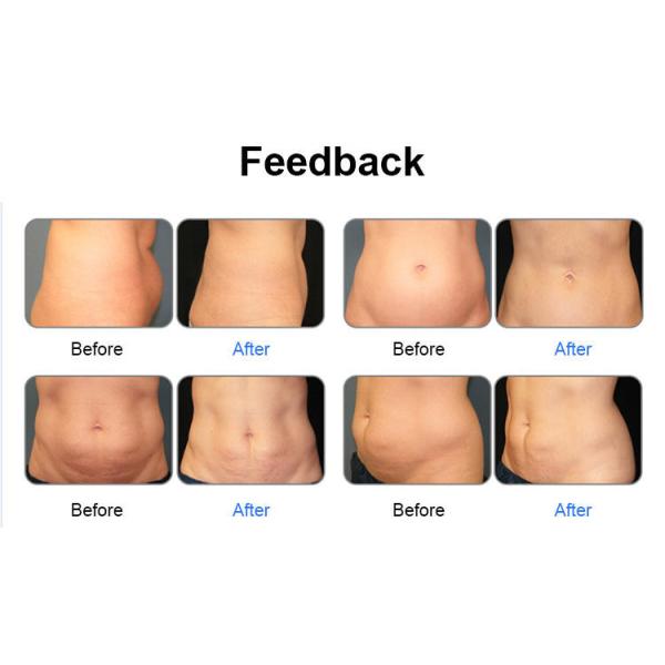 6D Diode Laser 532nm Ultrasound Weight Loss Machine 1-200mw Air Cooled