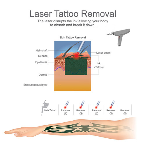1000J Maximal Energy ND Yag Laser Tattoo Removal Machine With Honeycomb Tip