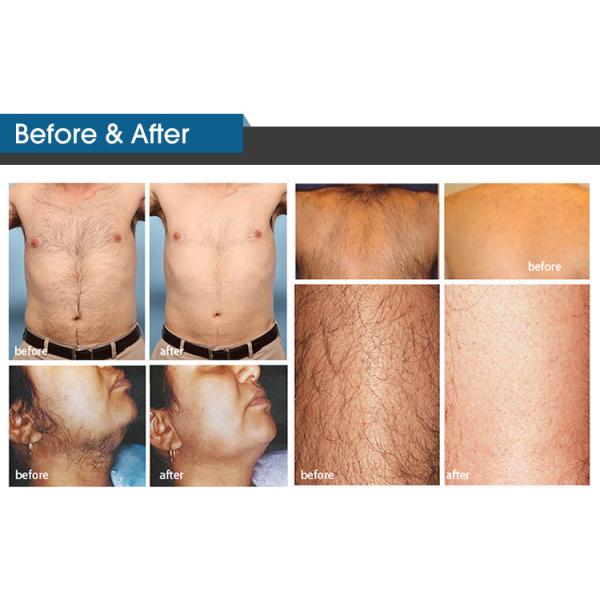 Epilation Definitive Laser Hair Removal Machine From ADSS Company