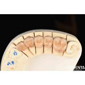 Bionic Development Leaves And Distinct Layers Of Zirconia All-Ceramic