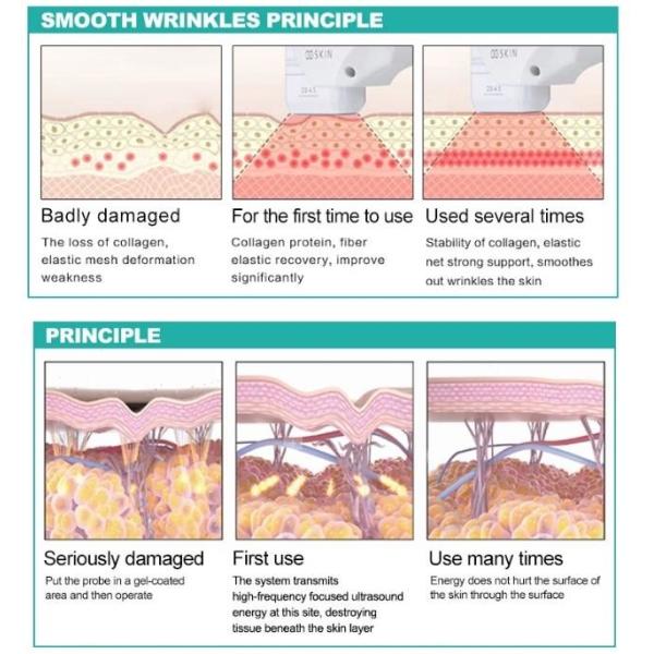 LF-438 korea hifu liposonic machine hifu face lifting body slimming machine