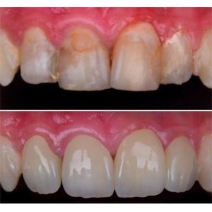 43%-57% Translucency 700-1200 MPa Bending Strength YUCERA Dental 89mm CAD/CAM 4D