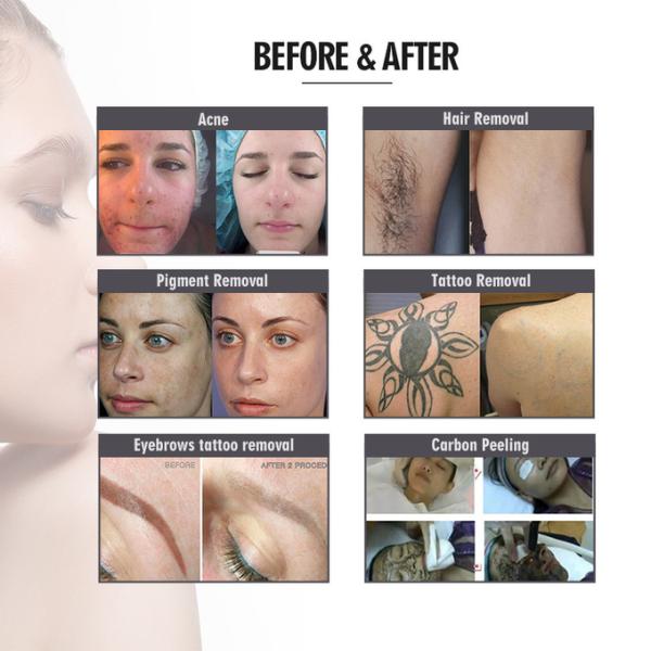 FDA Approved Hair Removal Machine Professional IPL Radio Frequency Elight IPL RF