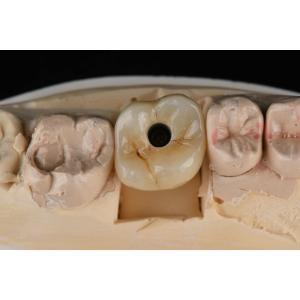 titanium 10mm Single Tooth Dental Implants Replacement Abutment Self Tapping