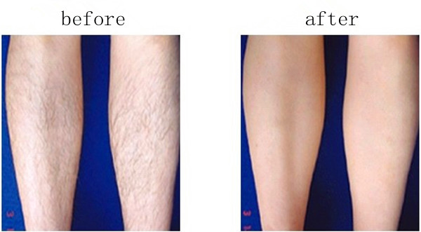 Home use mini ipl hair removal with CE