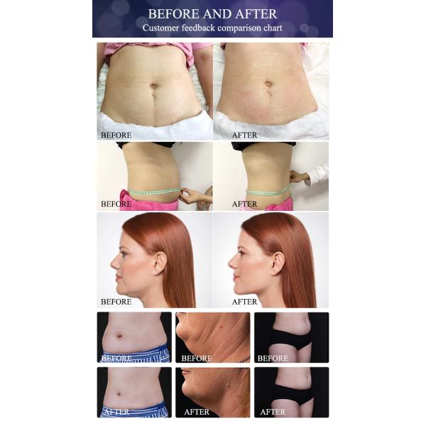 2020 New technology cryotherapy cryolipolysis body shaper slimming weight loss extracorporeal shock wave therapy equipme